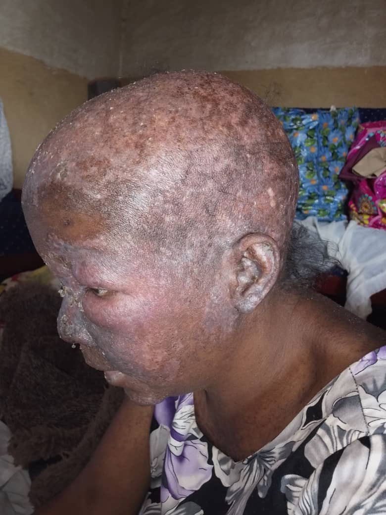 Ugandan Teacher Battles Lupus as High Treatment Costs Expose Gaps in Chronic Care